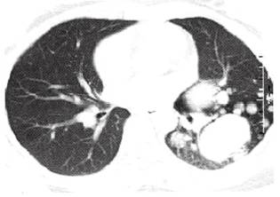 【病例】肺多发乳头状腺癌1例CT影像表现 【病例】肺多发乳头状腺癌1例CT影像表现