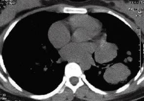 【病例】肺多发乳头状腺癌1例CT影像表现 【病例】肺多发乳头状腺癌1例CT影像表现