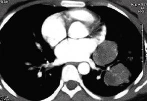 【病例】肺多发乳头状腺癌1例CT影像表现 【病例】肺多发乳头状腺癌1例CT影像表现