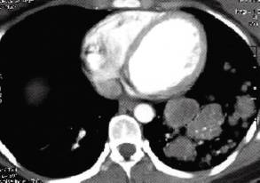 【病例】肺多发乳头状腺癌1例CT影像表现 【病例】肺多发乳头状腺癌1例CT影像表现