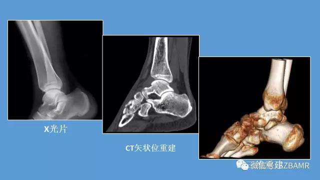 磁共振科普运动损伤之——跟腱篇 磁共振科普运动损伤之——跟腱篇