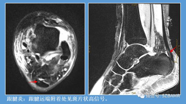 磁共振科普运动损伤之——跟腱篇