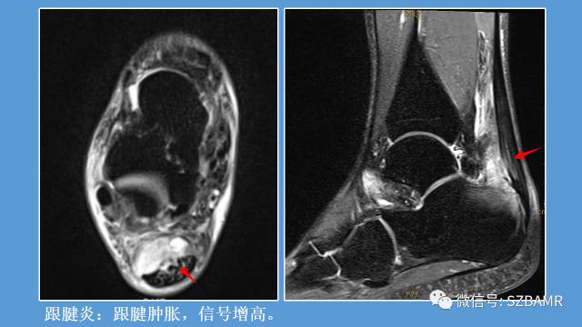磁共振科普运动损伤之——跟腱篇 磁共振科普运动损伤之——跟腱篇