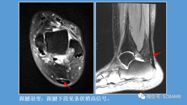 磁共振科普运动损伤之——跟腱篇 磁共振科普运动损伤之——跟腱篇
