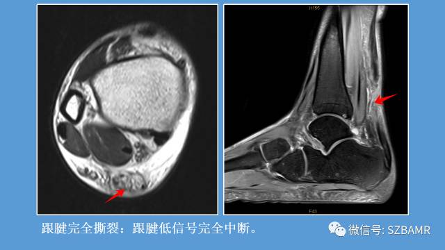 磁共振科普运动损伤之——跟腱篇 磁共振科普运动损伤之——跟腱篇