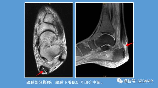 磁共振科普运动损伤之——跟腱篇 磁共振科普运动损伤之——跟腱篇