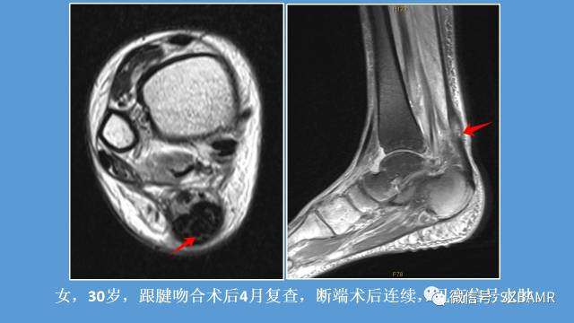 磁共振科普运动损伤之——跟腱篇 磁共振科普运动损伤之——跟腱篇