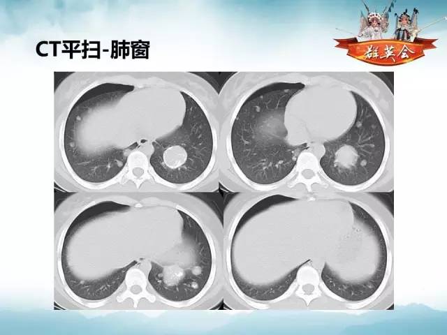 【病例】(肺)结节性硬化1例