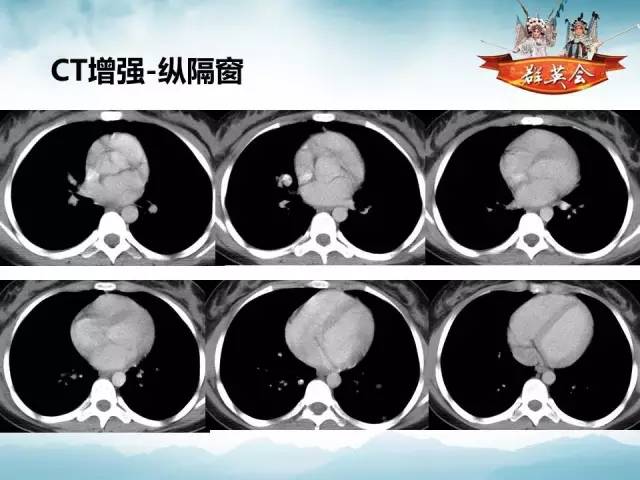 【病例】(肺)结节性硬化1例