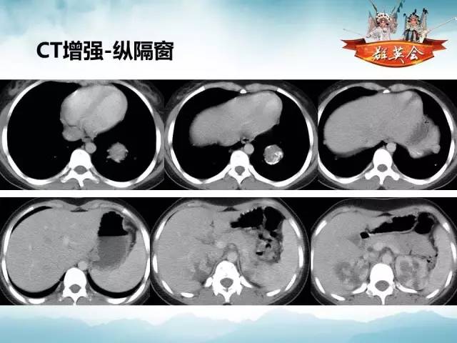 【病例】(肺)结节性硬化1例