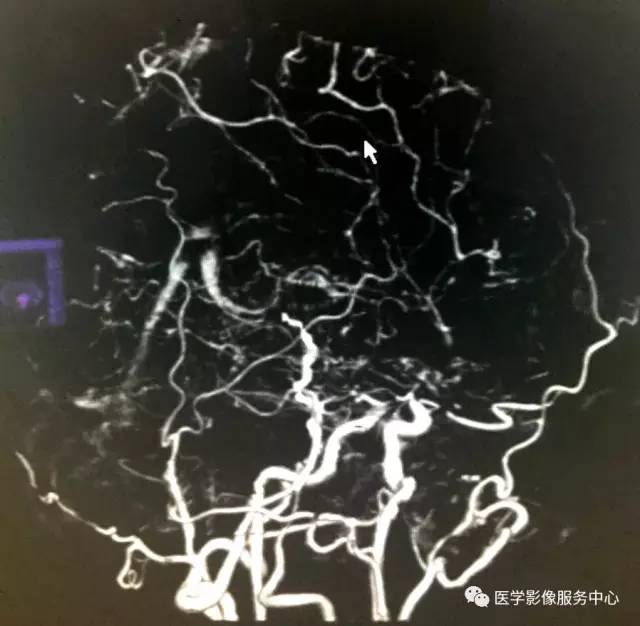 【病例】仅凭一层CT图像即可确诊这个疾病,你能做到吗? 【病例】仅凭一层CT图像即可确诊这个疾病,你能做到吗?