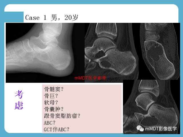【PPT】跗骨病变影像分析思路