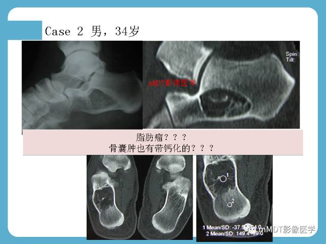 【PPT】跗骨病变影像分析思路