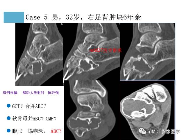 【PPT】跗骨病变影像分析思路