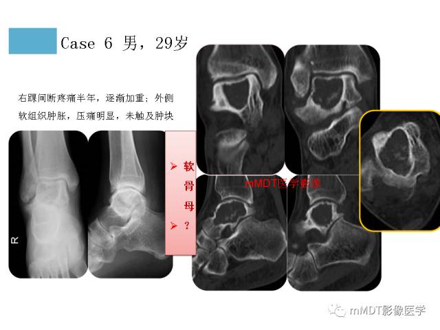 【PPT】跗骨病变影像分析思路
