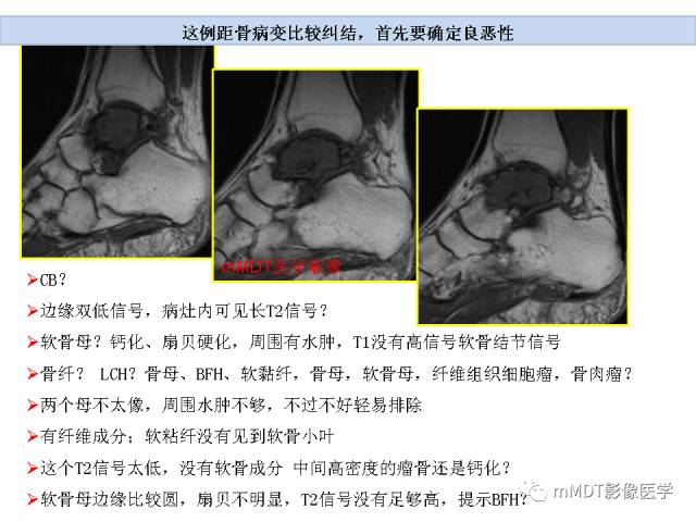 【PPT】跗骨病变影像分析思路
