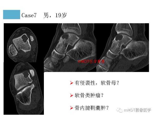 【PPT】跗骨病变影像分析思路