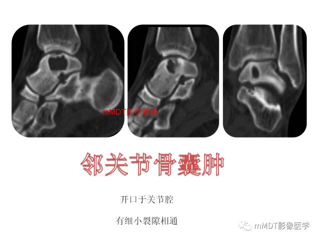 【PPT】跗骨病变影像分析思路