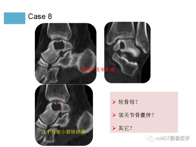 【PPT】跗骨病变影像分析思路