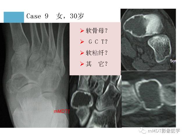 【PPT】跗骨病变影像分析思路