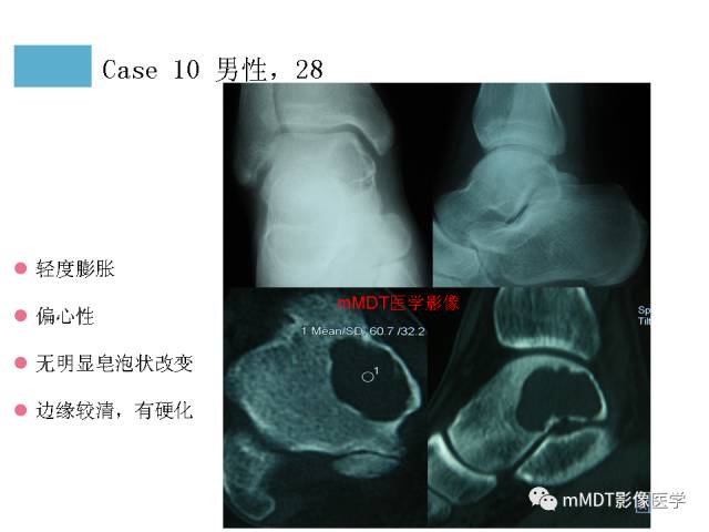 【PPT】跗骨病变影像分析思路