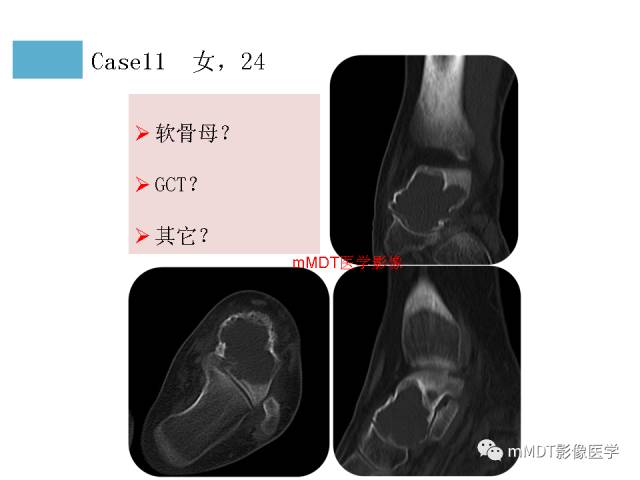 【PPT】跗骨病变影像分析思路