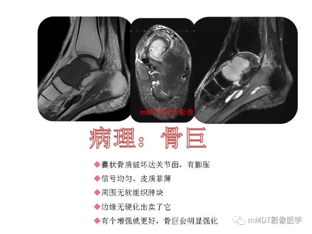 【PPT】跗骨病变影像分析思路