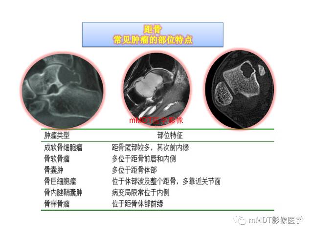 【PPT】跗骨病变影像分析思路