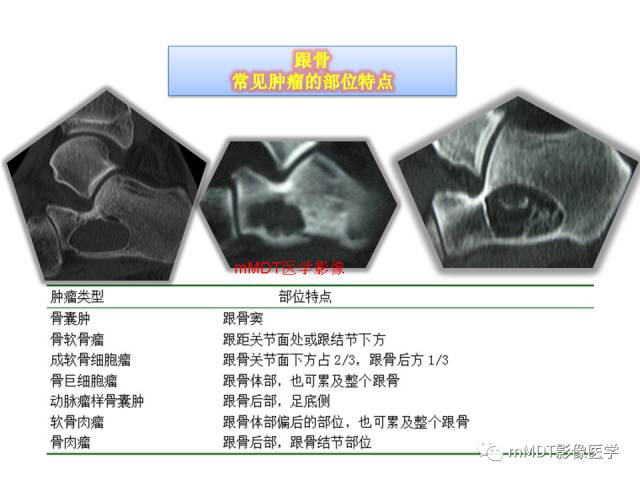 【PPT】跗骨病变影像分析思路