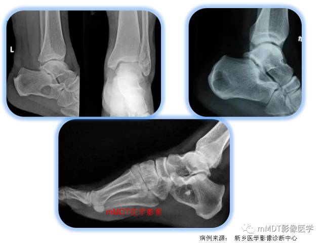【PPT】跗骨病变影像分析思路