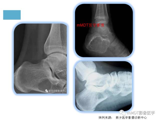 【PPT】跗骨病变影像分析思路