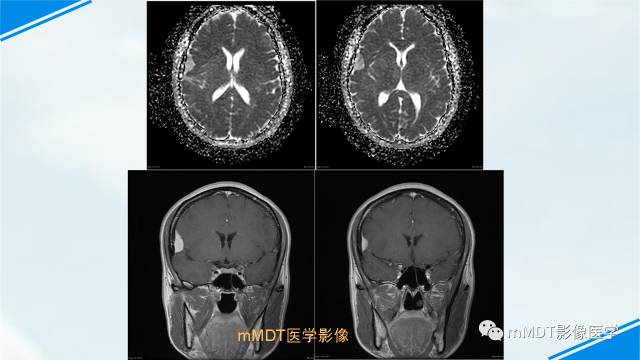 【PPT】脊索样脑膜瘤影像诊断