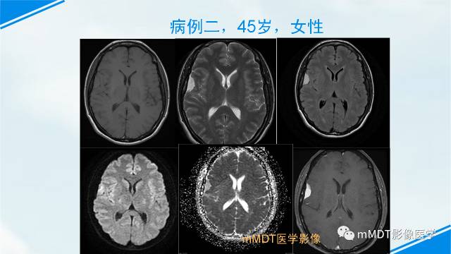 【PPT】脊索样脑膜瘤影像诊断