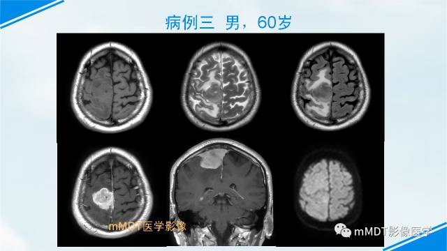 【PPT】脊索样脑膜瘤影像诊断