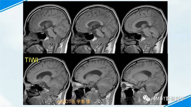 【PPT】脊索样脑膜瘤影像诊断