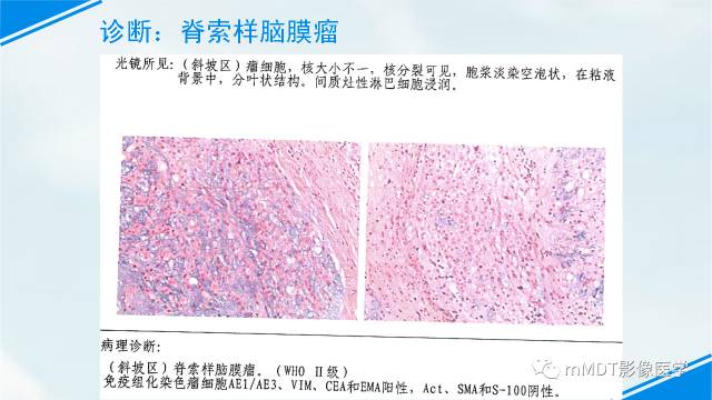 【PPT】脊索样脑膜瘤影像诊断