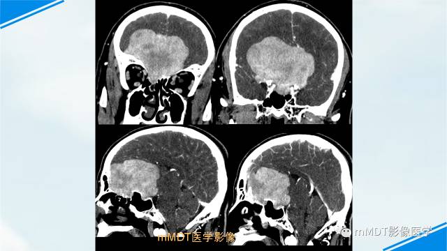 【PPT】脊索样脑膜瘤影像诊断
