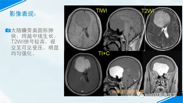 【PPT】脊索样脑膜瘤影像诊断