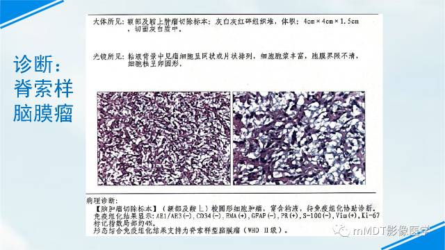 【PPT】脊索样脑膜瘤影像诊断
