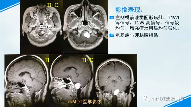 【PPT】脊索样脑膜瘤影像诊断