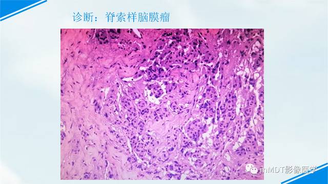 【PPT】脊索样脑膜瘤影像诊断