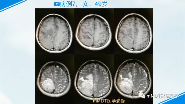 【PPT】脊索样脑膜瘤影像诊断