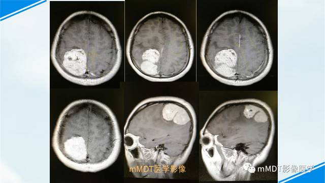 【PPT】脊索样脑膜瘤影像诊断