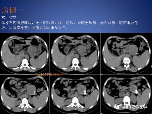 【PPT】胰腺实性假乳头状瘤诊断及鉴别