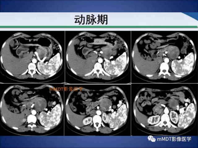 【PPT】胰腺实性假乳头状瘤诊断及鉴别