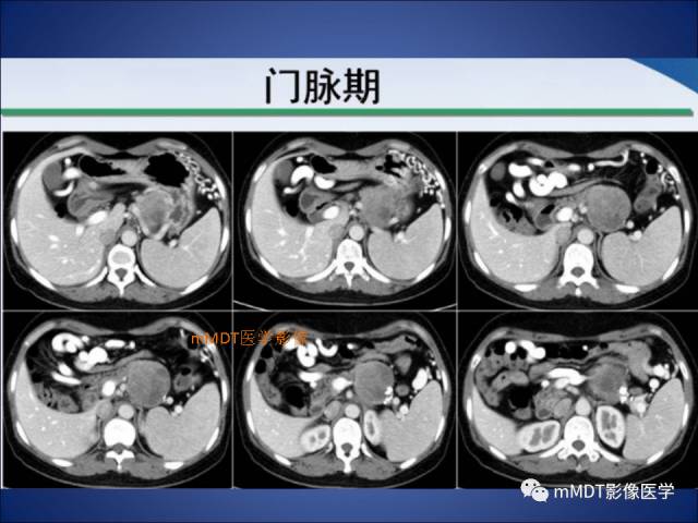 【PPT】胰腺实性假乳头状瘤诊断及鉴别