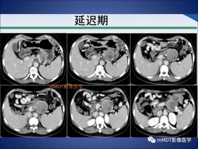 【PPT】胰腺实性假乳头状瘤诊断及鉴别