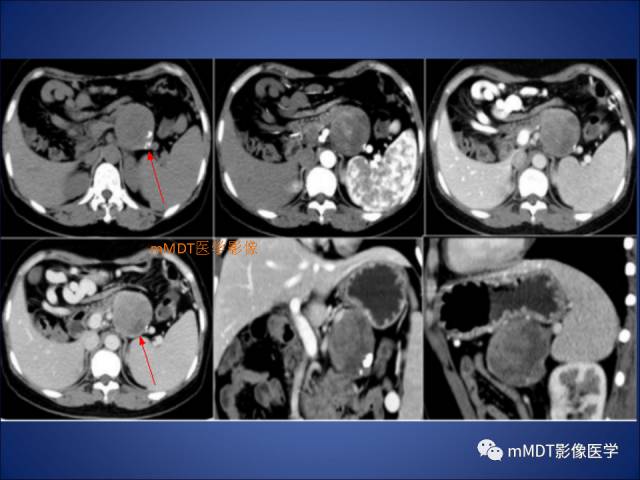 【PPT】胰腺实性假乳头状瘤诊断及鉴别