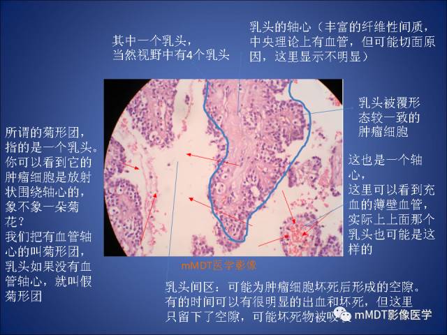 【PPT】胰腺实性假乳头状瘤诊断及鉴别