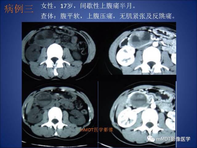 【PPT】胰腺实性假乳头状瘤诊断及鉴别